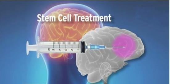 干细胞注射可防治脑中风后认知障碍